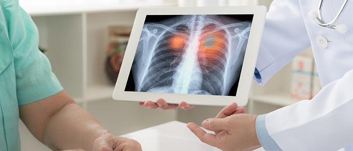 Lung Cancer: Overview, Causes and Symptoms