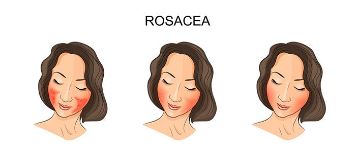 Effective Ways to Treat Rosacea Naturally at Home