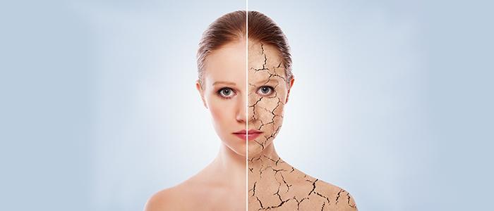 Ichthyosis vulgaris causes and symptoms