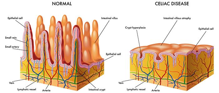 Overview of Celiac Disease and its Treatment