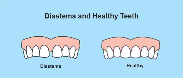 Diastema overview and treatments
