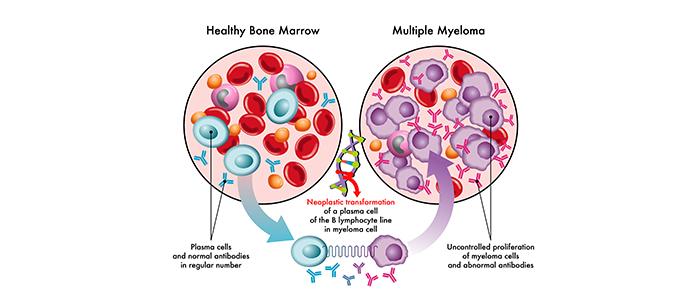 Know what is multiple myeloma and its treatment