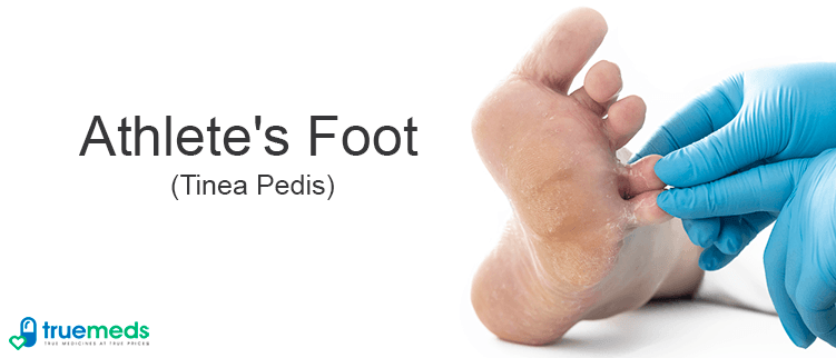 Athletes foot- A fungal skin infection