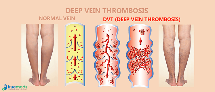 Deep vein thrombosis: who is at risk?