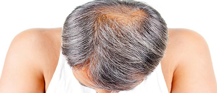 Premature Greying of Hair